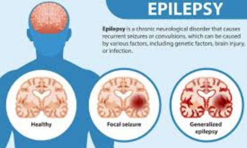International Epilepsy Day 2024 अंतर्राष्ट्रीय मिर्गी दिवस 2024